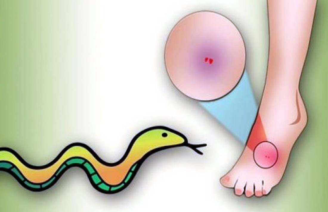 सर्पले डस्दा चुसेर उपचार : विश्वास कि बाध्यता ?