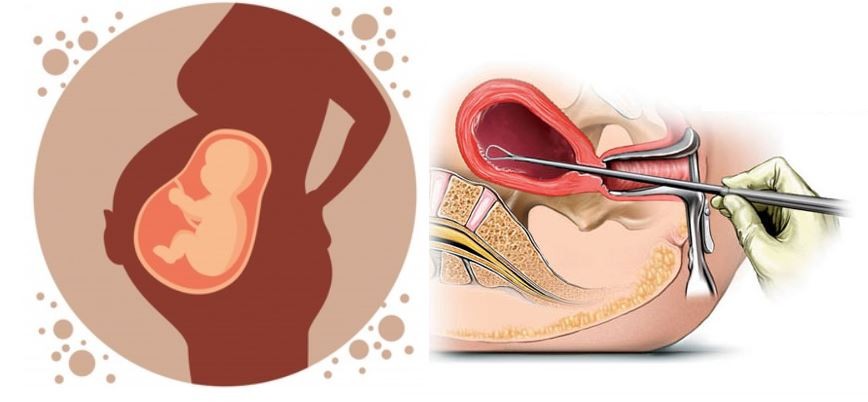 लिङ्ग परीक्षणपछिको गर्भपतनले महिलाको स्वास्थ्य जोखिममा