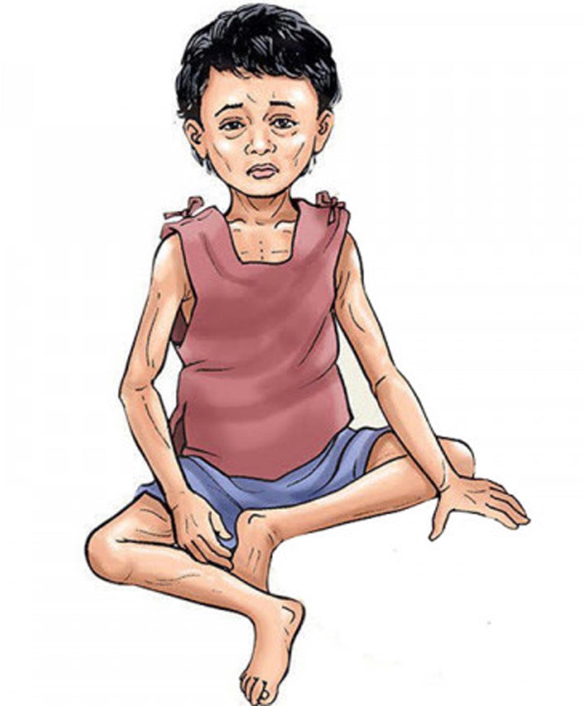 सामाजिक बहिस्करणको त्रासले लुकाइन्छ कुपोषण