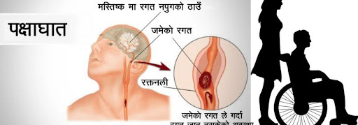 ‘विश्वमा बर्सेनि एक करोड ३० लाखलाई पक्षाघात’